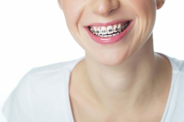 Metal Braces on Smiling Teeth