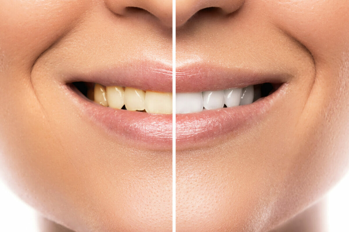 tooth-whitening-1200x800.jpeg