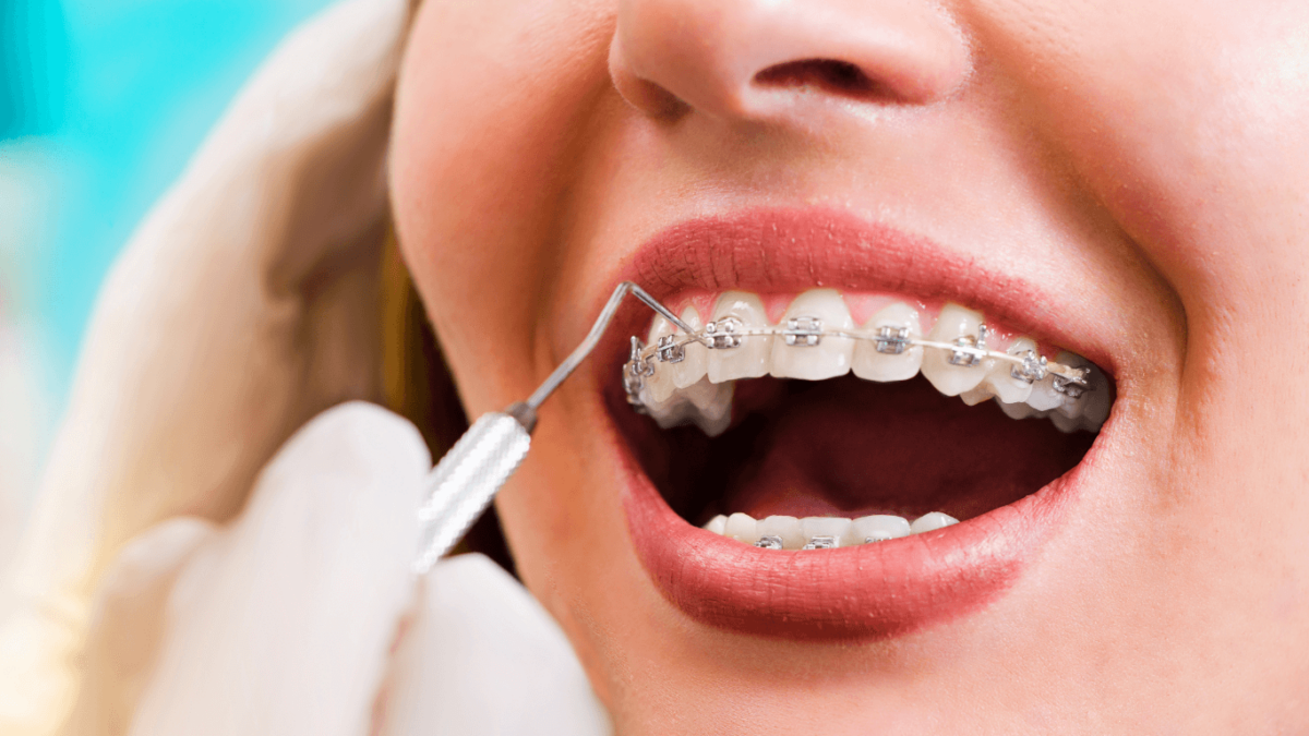 Choosing-the-Right-Braces-A-Detailed-Guide-1200x675.png