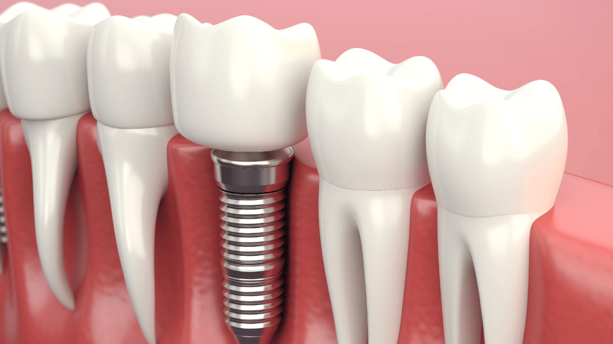 Dental-Implants-and-Facial-Structure-1200x675.png