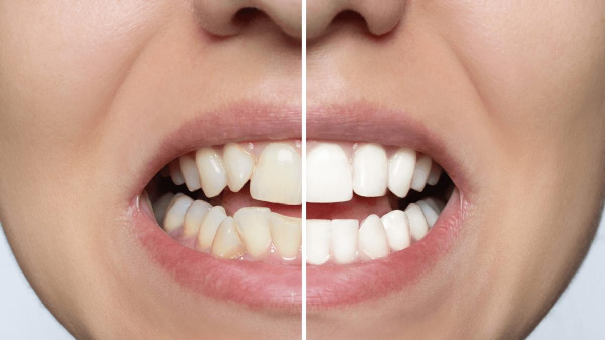 The-Aesthetic-and-Health-Benefits-of-Veneers-1200x675.png